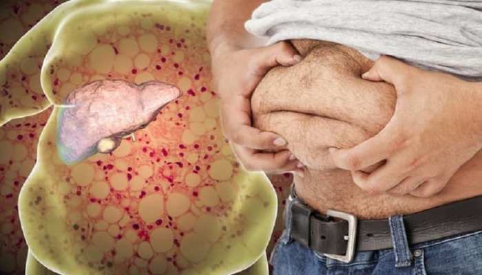 1057738 fatty liver