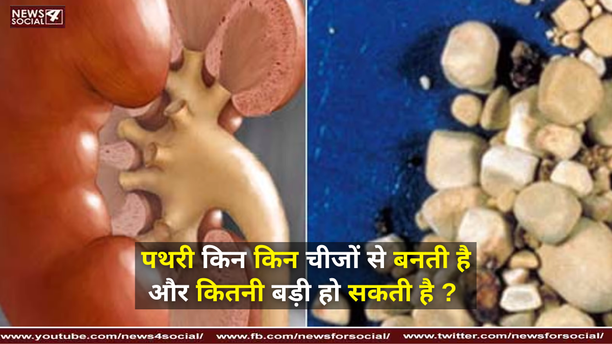 पथरी किन किन चीजों से बनती है और कितनी बड़ी हो सकती है ?